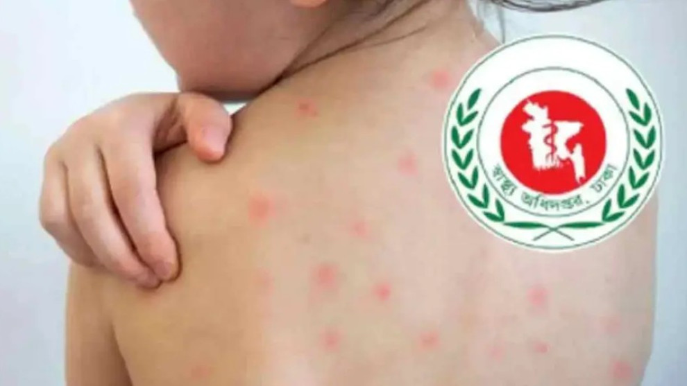 হামের উপসর্গে ২৪ ঘণ্টায় আরও ৭ মৃত্যু